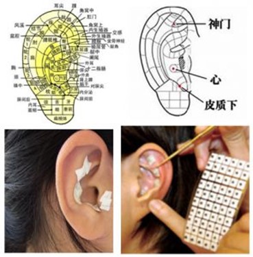 《“耳穴压豆”方法治疗各种急慢性皮肤病》