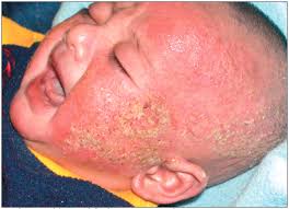 《儿童特应性皮炎（婴儿湿疹）的日常家庭护理》