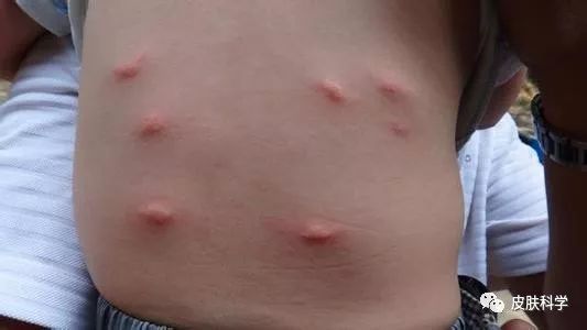 《这个季节，注意预防丘疹性荨麻疹来找麻烦。》
